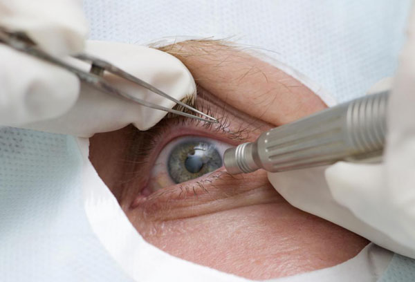 u eye-surgery-closeup.jpg